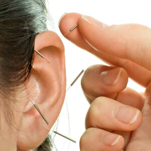 Auricular Acupuncture for Stress Management